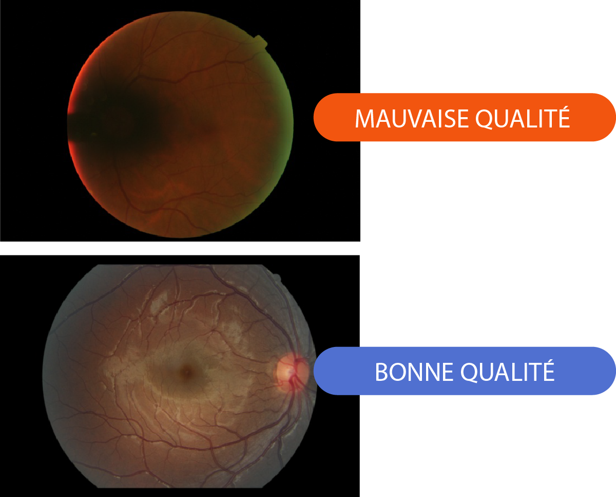 Analyse de la qualité de l'image de rétine